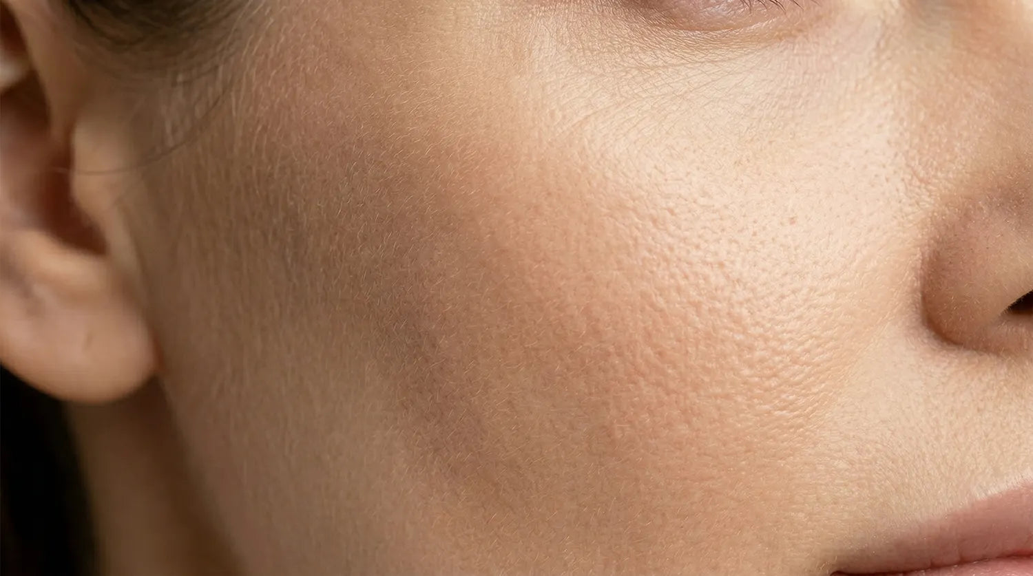 Fillers Pommettes Injectables
