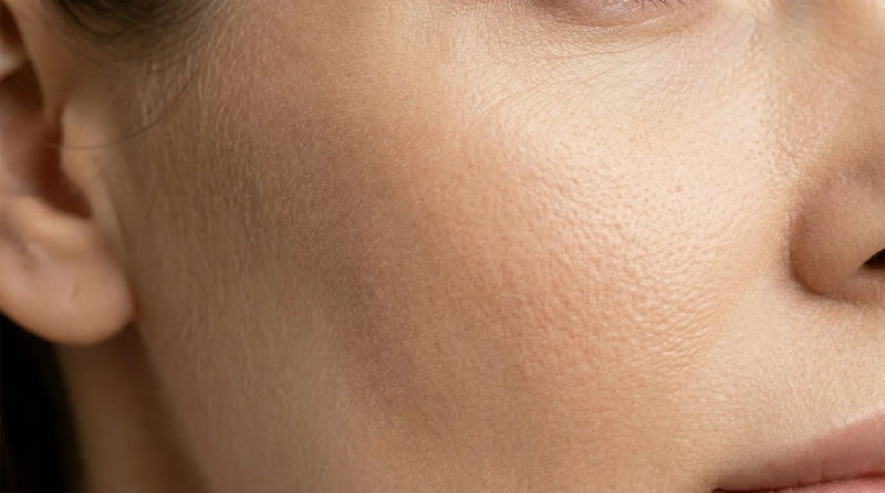 Filler joues pommettes